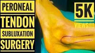 Peroneal Tendon Subluxation Repair (Detailed Surgical Technique)
