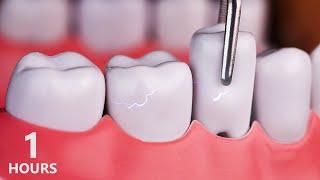 ASMR Your sore teeth get better1hours