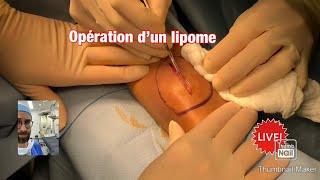 Chirurgie d’ablation pour le traitement d’un lipome graisseux