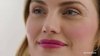 Lip Fillers/Lip Augmentation/Lip Fullness (Natural looking and Long Lasting Results)