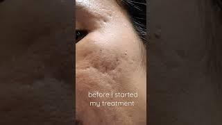 Amazing change | Microneedling | 4th treatment | 4 days after treatment | acne Journey | | HHerman