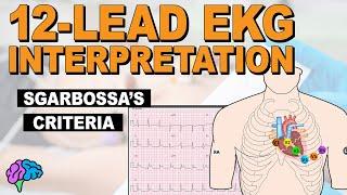 Sgarbossa's Criteria - HOW TO Identify AMI with LBBB on 12-lead EKG