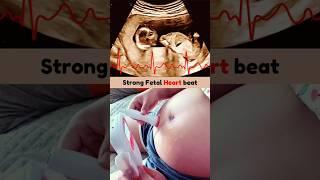 Strong Audible Fetal Heart Beat  Boy or Girl Heartbeat | Can you know Baby Gender From Heartbeat?