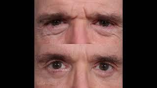 Blepharoplasty Before and After with Dr. Paul Nassif