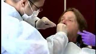 Complete Denture Procedure ; 02 Mandibular Preliminary Impression