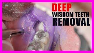 Wisdom Teeth Removal | Tooth Sectioning Procedure. Surgical Guide + Online Courses!