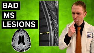 Bad MS MRI Lesions