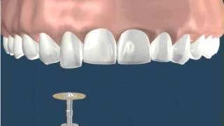 Dentistry Recontouring Teeth 1