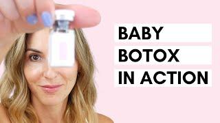 Baby Botox | Using a Dermastamp for Microneedling