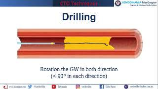 Guide wire displacement techniques