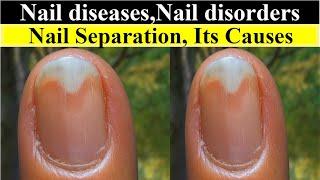 Nail separation| onycholysis| nakhun ka tootna