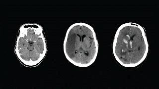 How to Read a CT Scan of the Head - MEDZCOOL