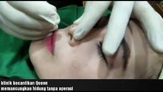 Memancungkan hidung tanpa operasi by Klinik Kecantikan Queen