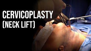 Neck Lift (Cervicoplasty) - Dr. Paul Ruff | West End Plastic Surgery