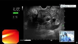 EUS guided FNB of mass in head of pancreas