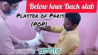 #plater#pop#bandage #below#knee#back#slab#drmujibar #treatment#ভাঙ্গা#পায়ের#প্লাস্টার .BK PLASTER.