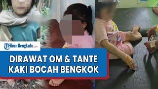 Sedih, Nasib Pilu Bocah Perempuan Diduga Dianiaya Om dan Tante Hingga Kaki Bengkok Permanen di Nias