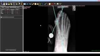 Foot and Ankle Deformity Correction with Dr. Noman Siddiqui - Bunion Correction