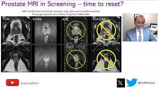 MRI in Prostate Cancer Screening  - Time to Reset