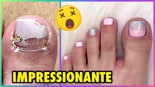 TRANSFORMAÇÃO DAS UNHAS DOS PÉS + RECONSTRUÇÃO COM POLYGEL