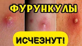 Фурункулы исчезнут!