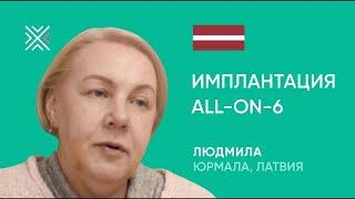 Имплантация All-on-6 под ключ в Минске