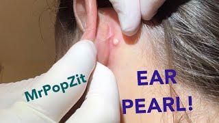 Follicular cyst removal. I find a gem behind the ear and extract it.