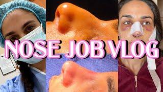 NOSE JOB VLOG  *emotional reveal*  rhinoplasty | Closet Raid