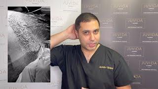 The Importance Of Implanting | Juvida Clinics