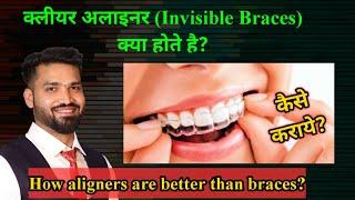 what is clear aligner? How its better than braces?