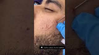 (Subcision) تقنية تقطيع الالياف لعلاج ندبات حب الشباب وعلاج حفر الوجه