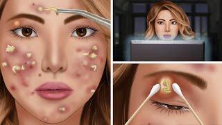 [ASMR] eye treatment animation | eye pimple | Acne Removal