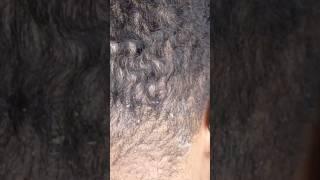 Dandruff in my husband scalp #dandruff #scratching #scalp #blacklove #god