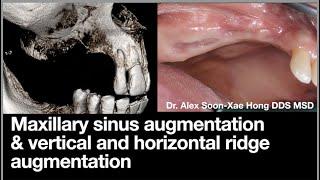 Maxillary sinus augmentation & vertical-horizontal ridge augmentation GBR Dr Alex Hong