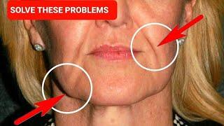 SAGGING JOWLS and NASOLABIAL FOLDS | Sagging cheeks and smile lines