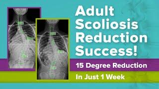 Adult Scoliosis Reduction Success! 15 Degree Reduction In Just 1 Week