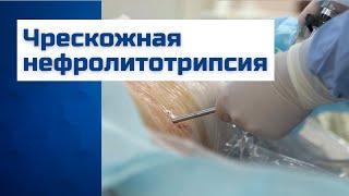 Чрескожная нефролитотрипсия. Камни в почках лечение в Москве