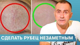 Как избавиться от рубцов на лице (шрамы, акне, послеоперационные) Хирург Караванов Дмитрий