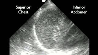 How to: Trauma FAST Exam - LUQ Exam