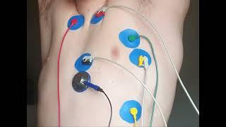 irregular visible heartbeat | heartbeat sound | ecg steth