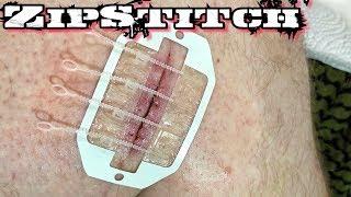 ZipStitch | World's Most Advanced Wound Closure Device!