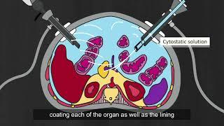 Pressurized Intraperitoneal Aerosol Chemotherapy (PIPAC) | Peritoneal Carcinomatosis Patients