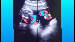 Posterior upper segment placenta gender | 22 weeks pregnant | 5 months pregnant scan | babygirl scan