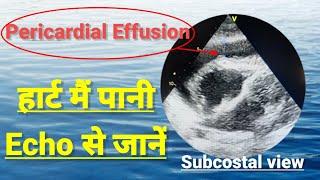 Pericardial effusion, echocardiography of pericardial effusion,  हार्ट मैं पानी भर जाना