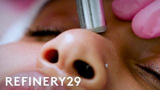 What Microdermabrasion Looks Like Up Close | Macro Beauty | Refinery29