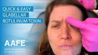 Quick & Easy Glabellar Botulinum Toxin Injection