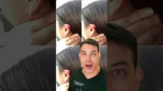 How do you treat that massive keloid #shorts | 208SkinDoc Dr. Dustin Portela Dermatologist