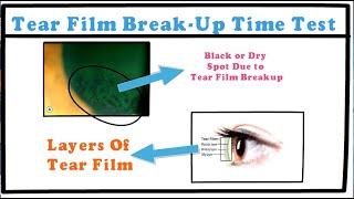 Tear Film Break-up Time Test (Within 1:30 min)