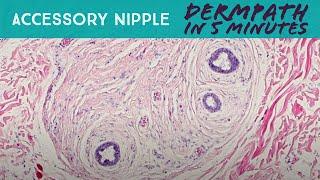 Extra Nipple under the microscope (third nipple, accessory nipple, dermpath, pathology, dermatology)