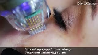 Микроигольчатый RF Endymed/Фракционный RF вокруг глаз